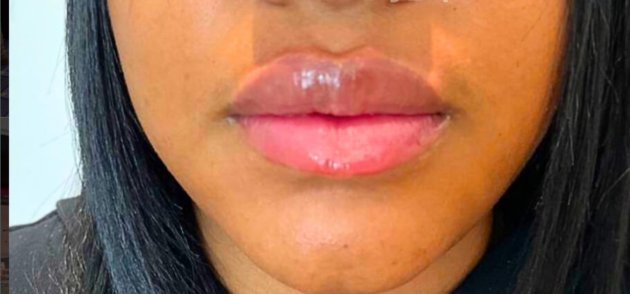 Dermal Fillers - After