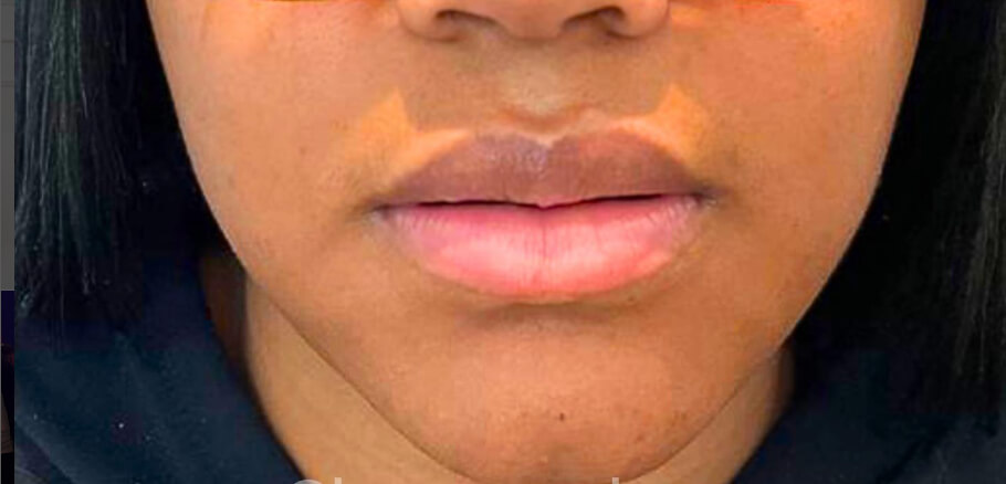 Dermal Fillers - Before