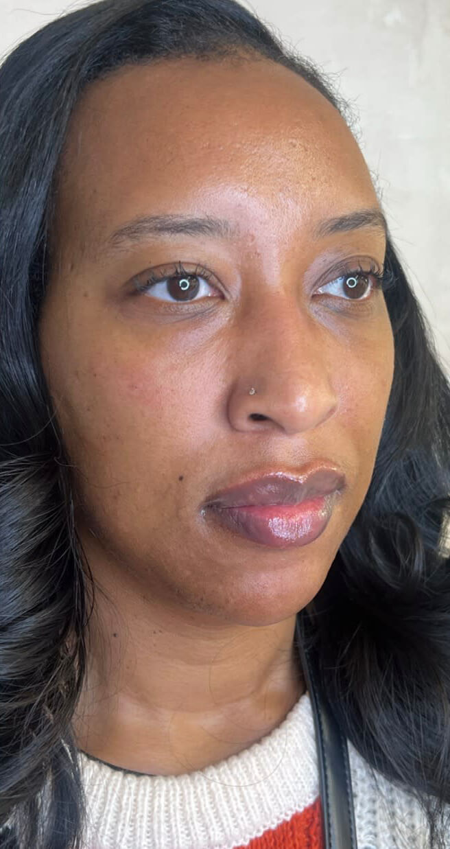 Dermal Fillers image - After