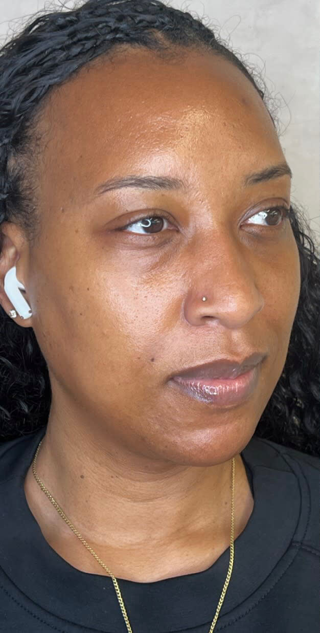 Dermal Fillers image - Before