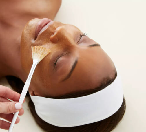 chemical peel maryland